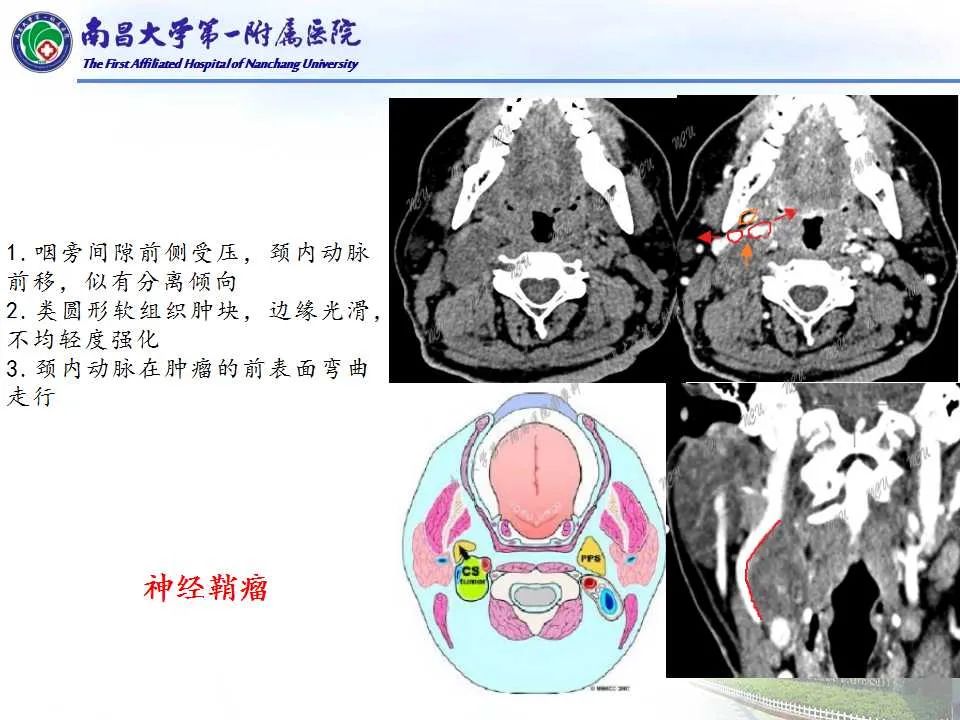 影像PPT - 【PPT】咽旁间隙——你别动-19