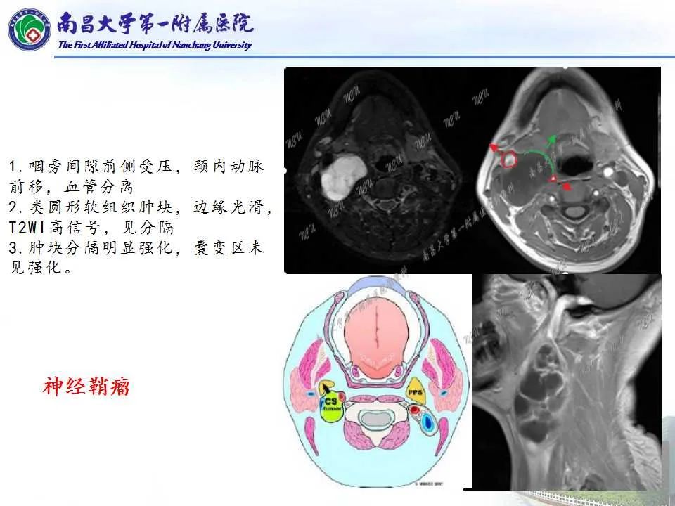 影像PPT - 【PPT】咽旁间隙——你别动-20