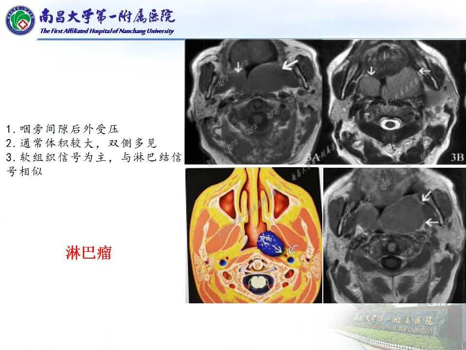 影像PPT - 【PPT】咽旁间隙——你别动-22