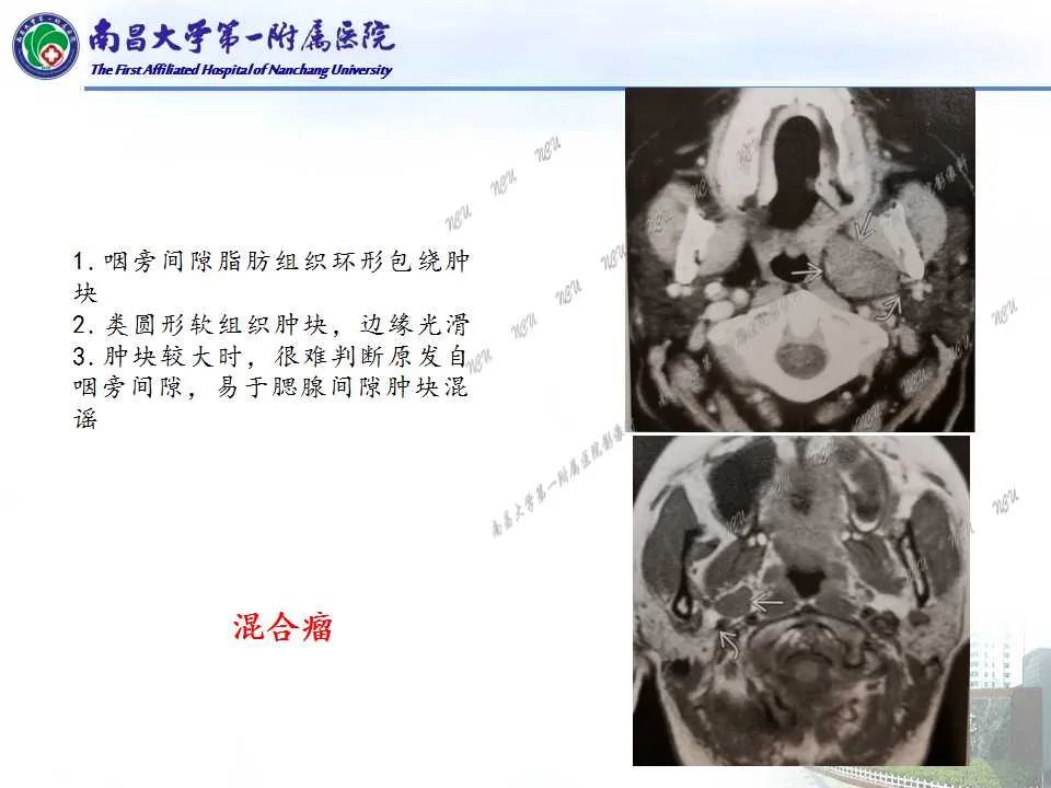 影像PPT - 【PPT】咽旁间隙——你别动-23