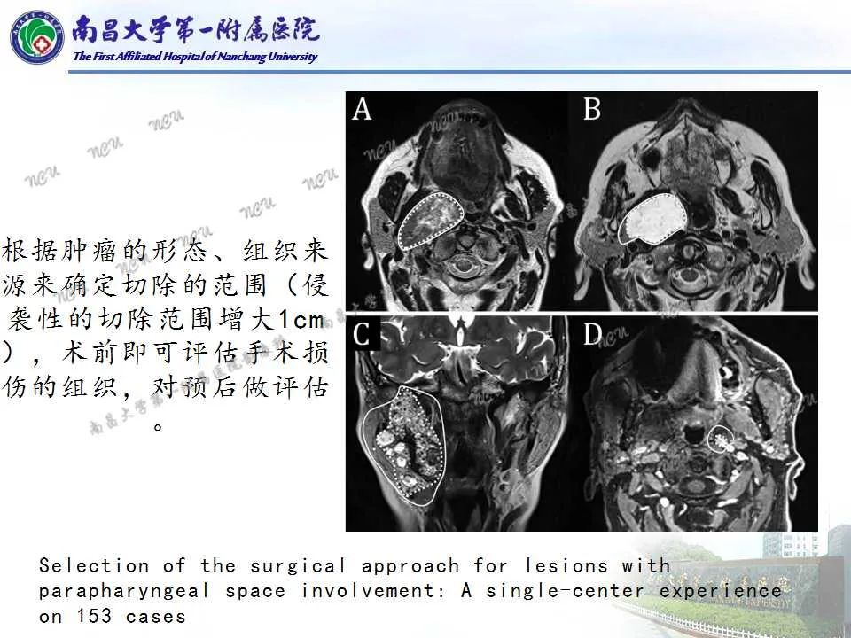 影像PPT - 【PPT】咽旁间隙——你别动-27