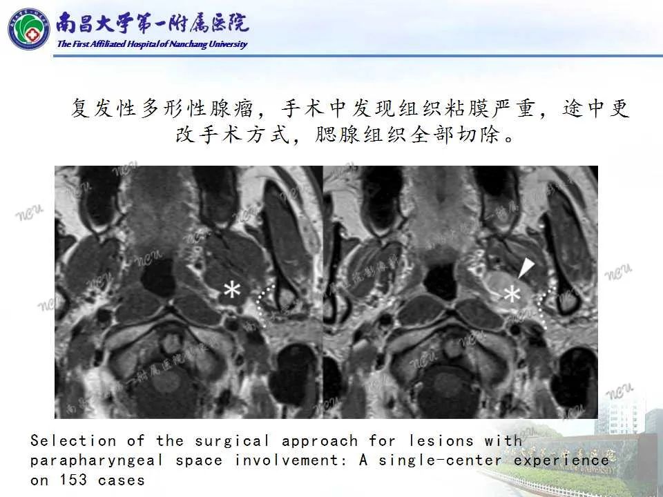 影像PPT - 【PPT】咽旁间隙——你别动-28