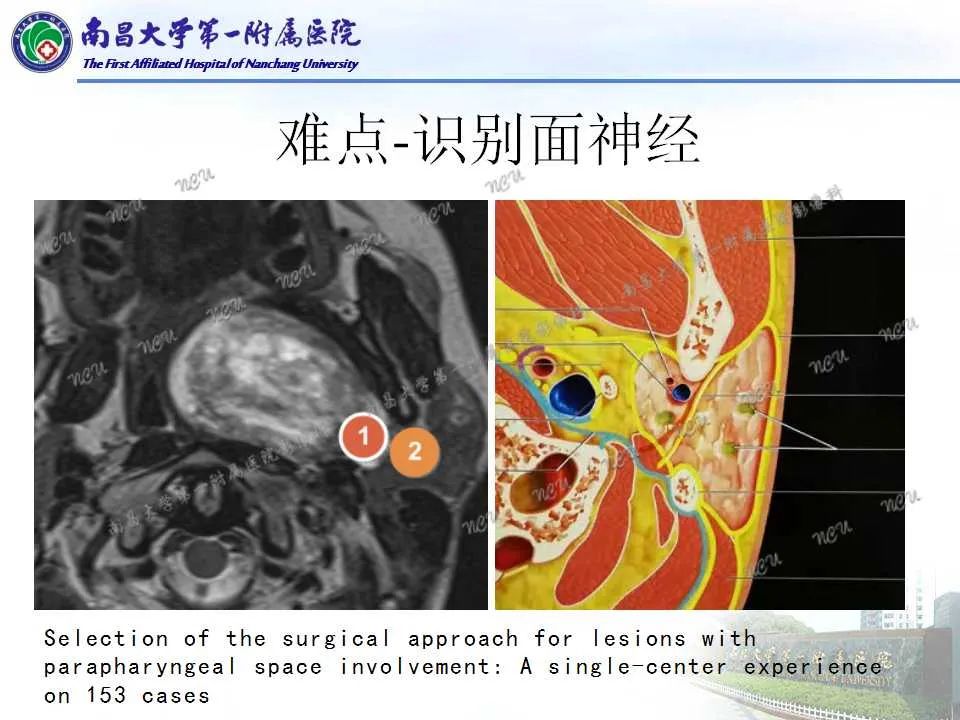 影像PPT - 【PPT】咽旁间隙——你别动-29