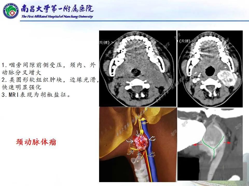影像PPT - 【PPT】咽旁间隙——你别动-21