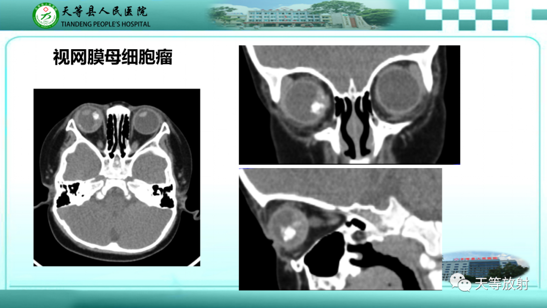 影像PPT - 【PPT】眼眶分区及各分区常见疾病-12
