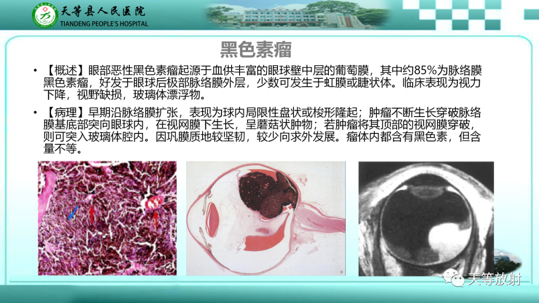 影像PPT - 【PPT】眼眶分区及各分区常见疾病-13