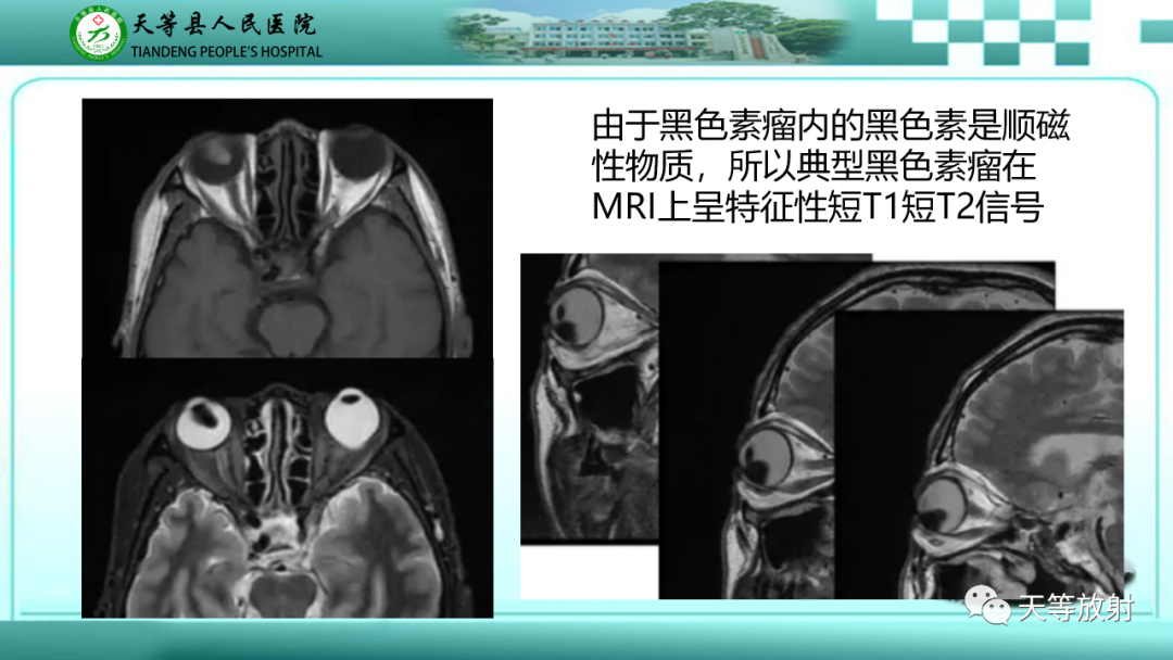 影像PPT - 【PPT】眼眶分区及各分区常见疾病-14