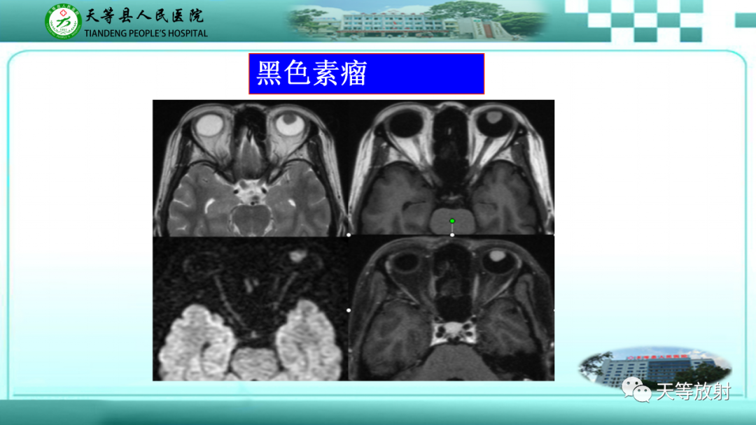 影像PPT - 【PPT】眼眶分区及各分区常见疾病-15