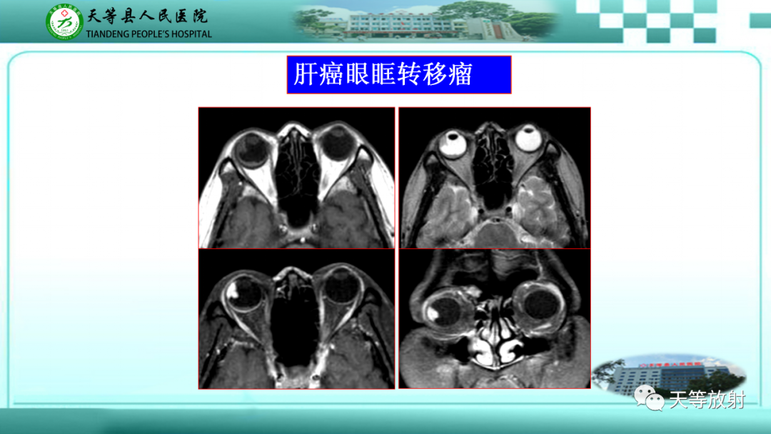 影像PPT - 【PPT】眼眶分区及各分区常见疾病-16
