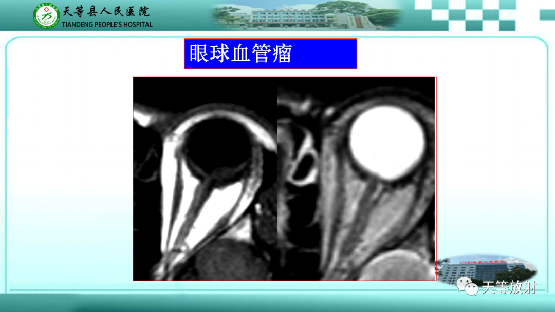 影像PPT - 【PPT】眼眶分区及各分区常见疾病-18