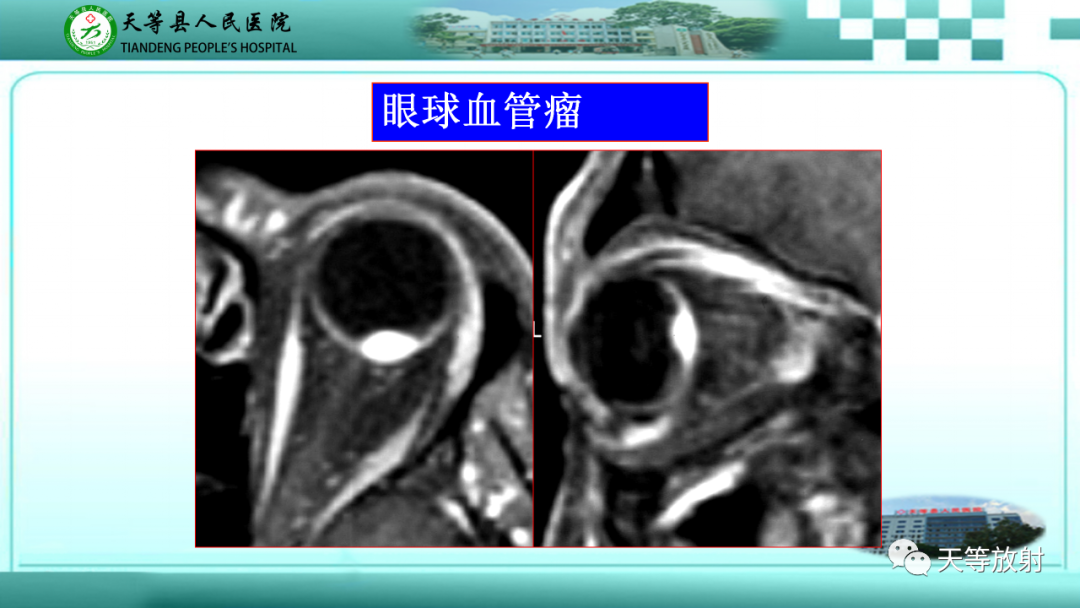 影像PPT - 【PPT】眼眶分区及各分区常见疾病-19