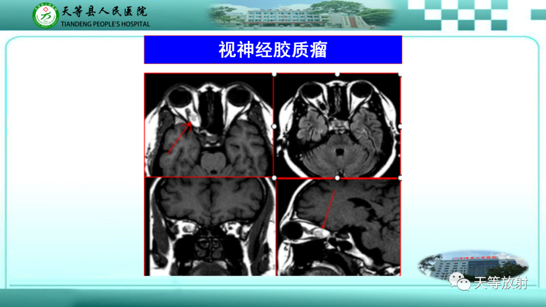影像PPT - 【PPT】眼眶分区及各分区常见疾病-21