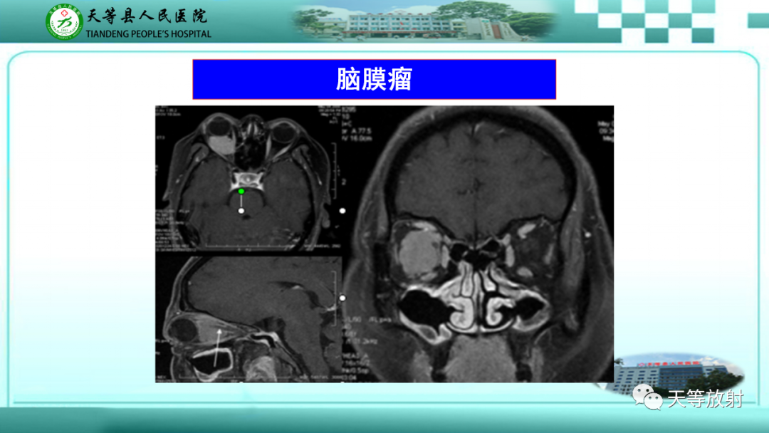 影像PPT - 【PPT】眼眶分区及各分区常见疾病-22