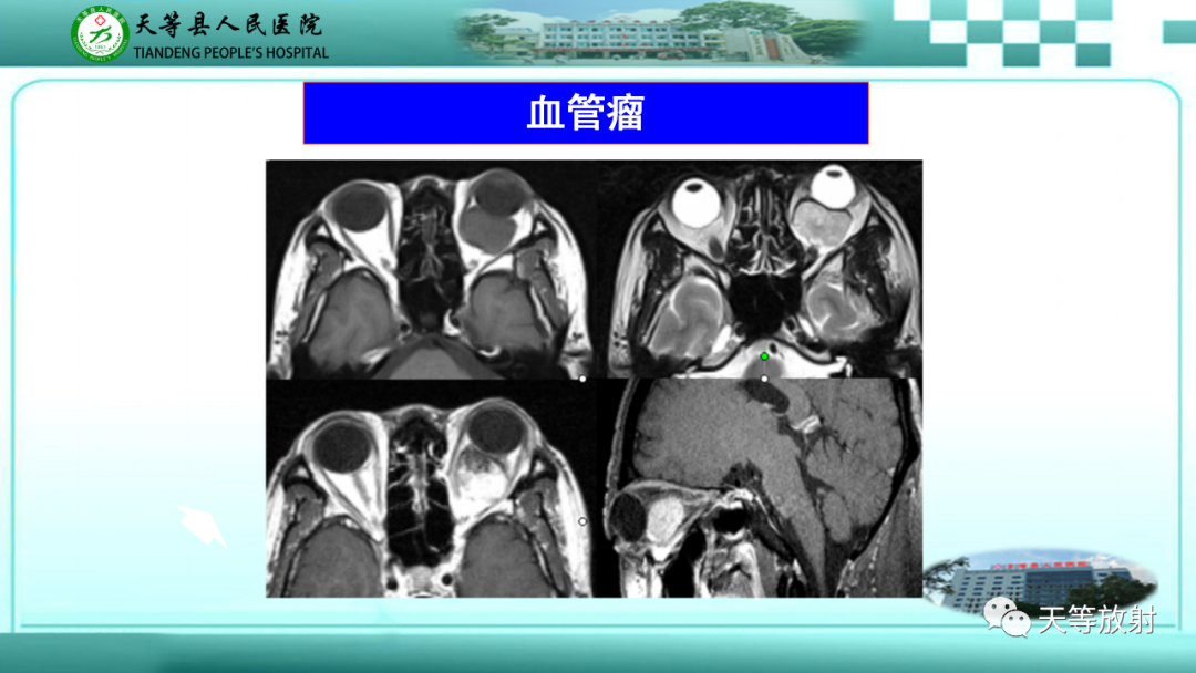 影像PPT - 【PPT】眼眶分区及各分区常见疾病-25