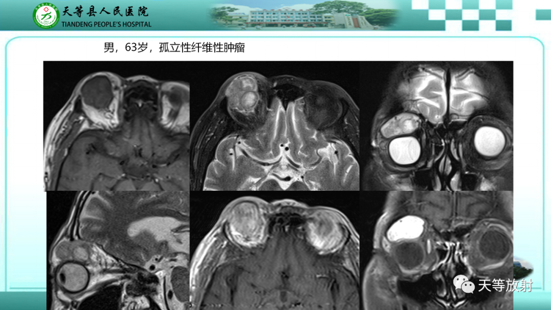 影像PPT - 【PPT】眼眶分区及各分区常见疾病-30