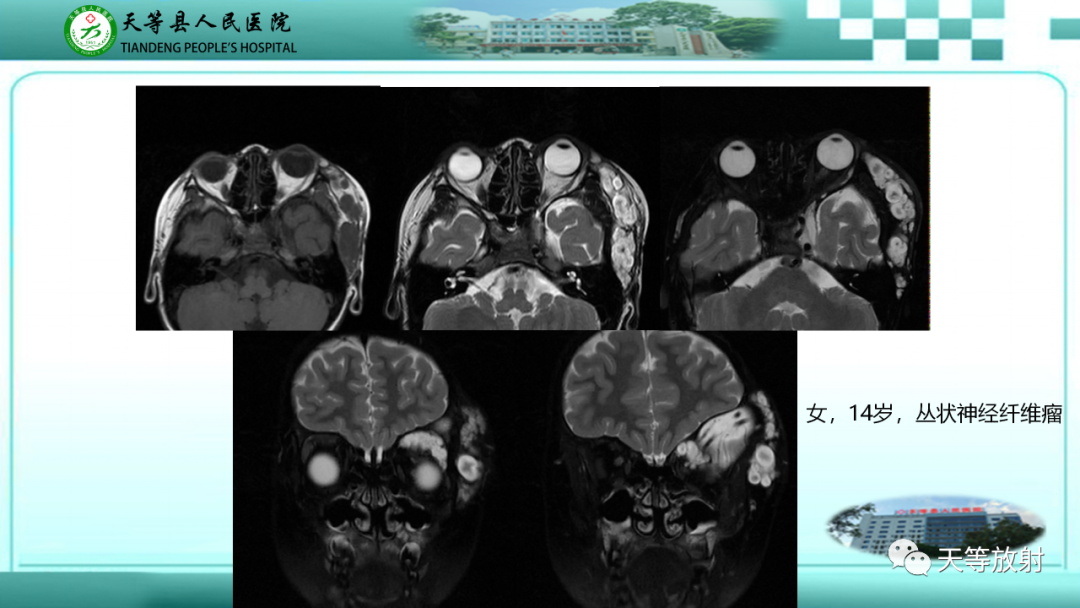 影像PPT - 【PPT】眼眶分区及各分区常见疾病-31