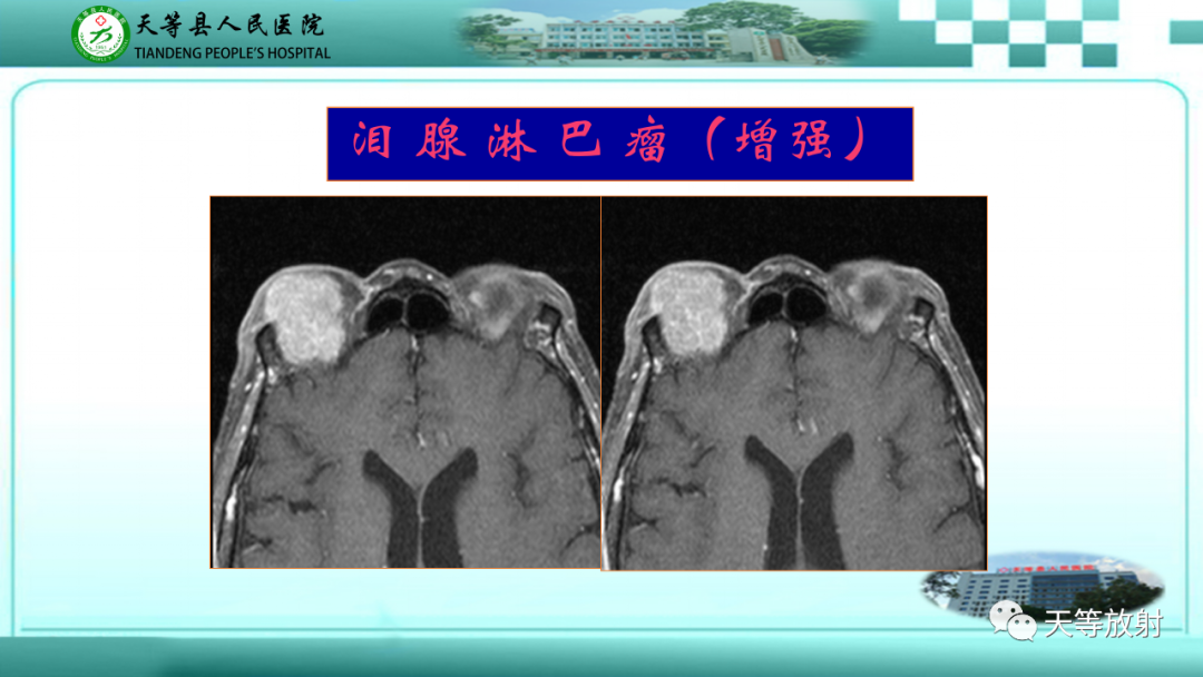 影像PPT - 【PPT】眼眶分区及各分区常见疾病-35