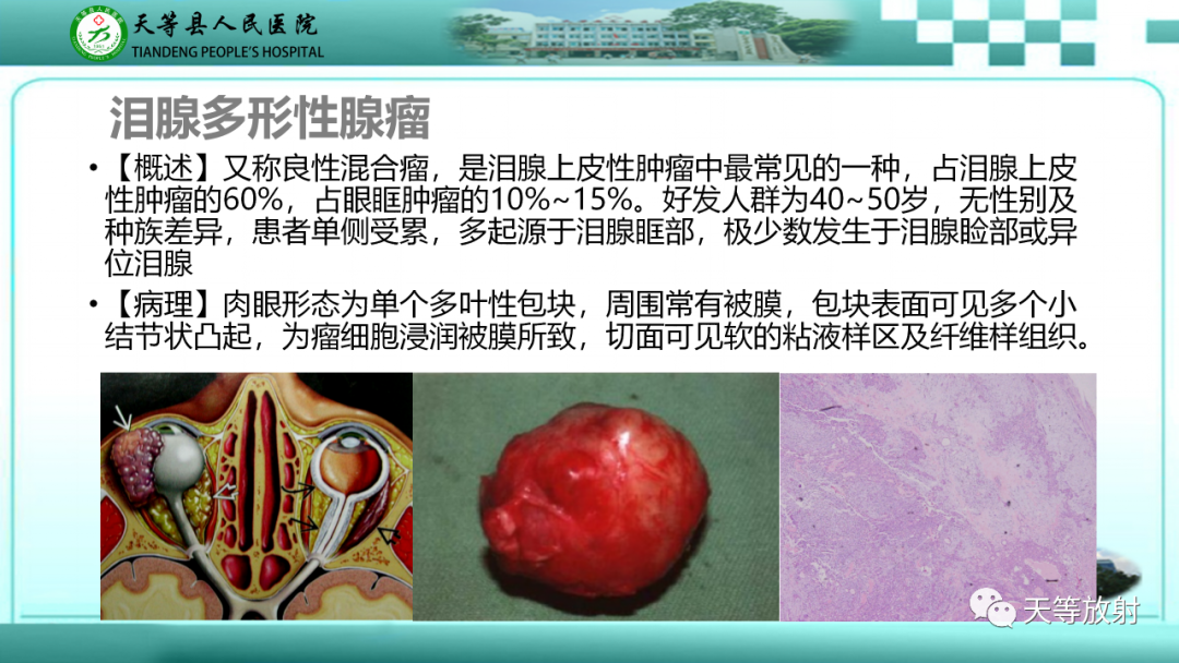 影像PPT - 【PPT】眼眶分区及各分区常见疾病-36