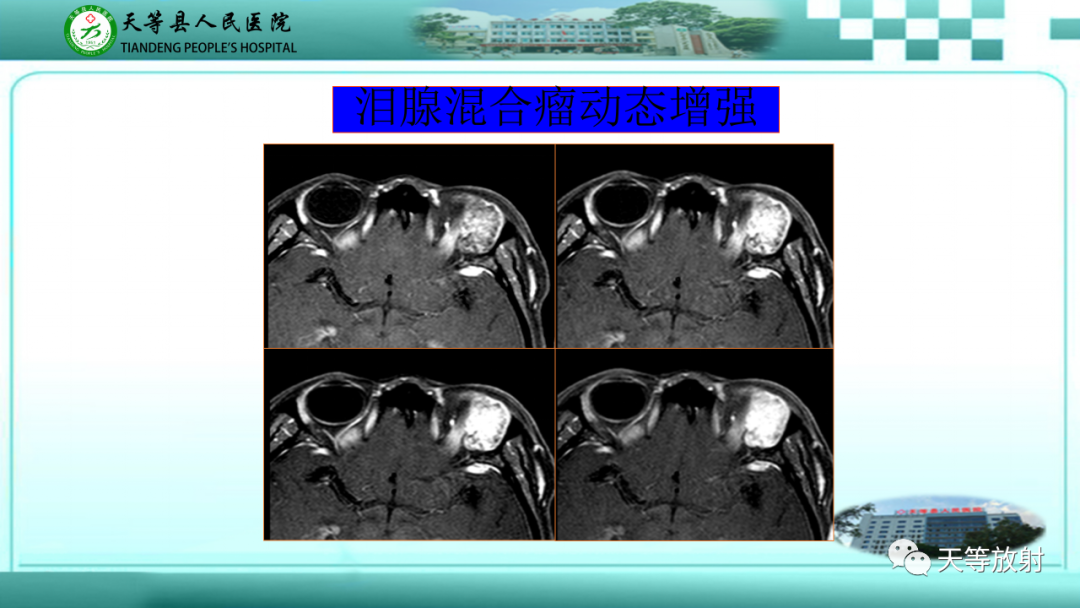 影像PPT - 【PPT】眼眶分区及各分区常见疾病-38