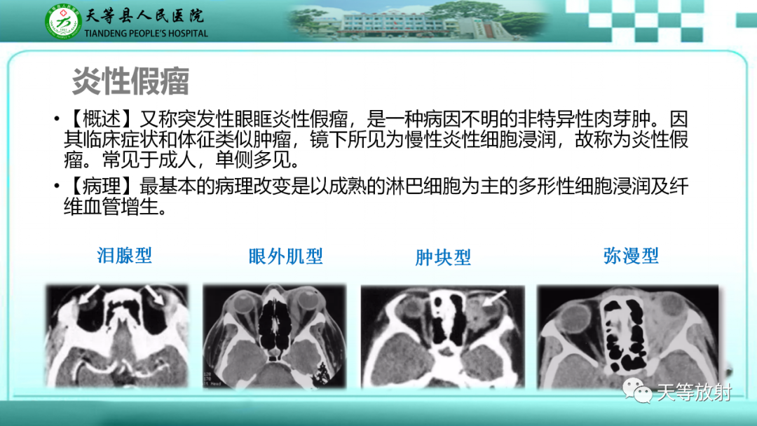 影像PPT - 【PPT】眼眶分区及各分区常见疾病-39