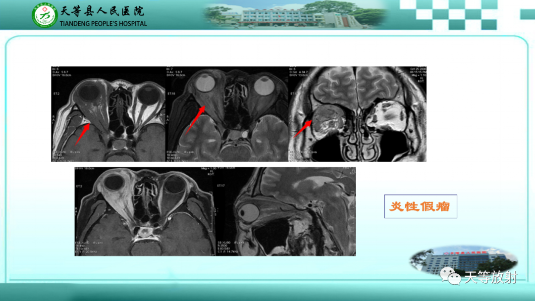 影像PPT - 【PPT】眼眶分区及各分区常见疾病-40
