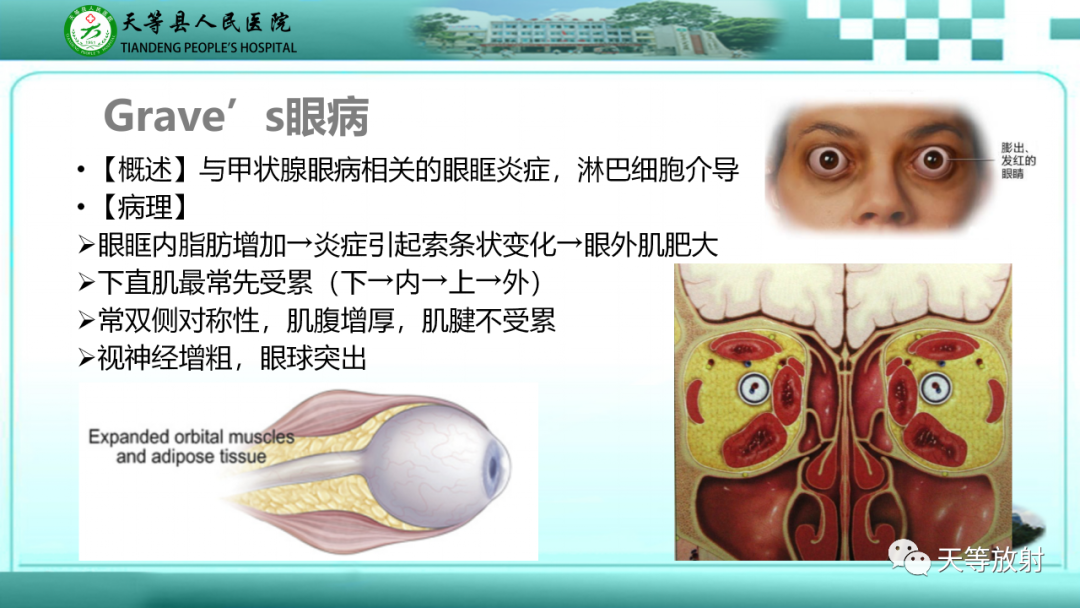 影像PPT - 【PPT】眼眶分区及各分区常见疾病-41
