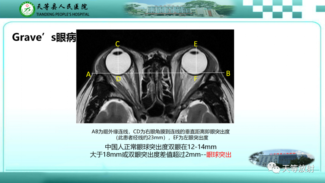 影像PPT - 【PPT】眼眶分区及各分区常见疾病-42