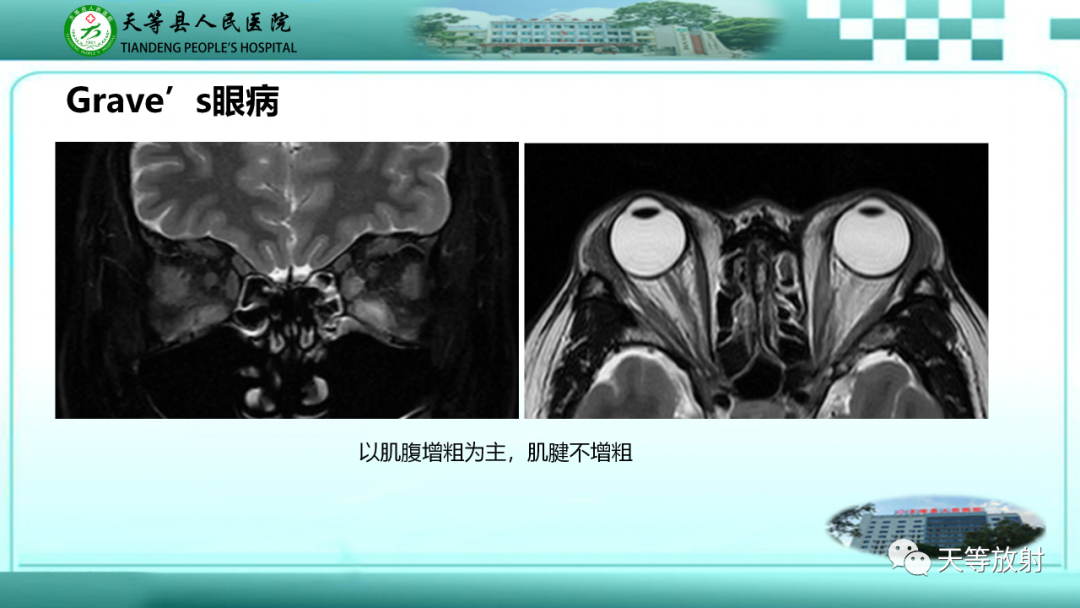 影像PPT - 【PPT】眼眶分区及各分区常见疾病-43
