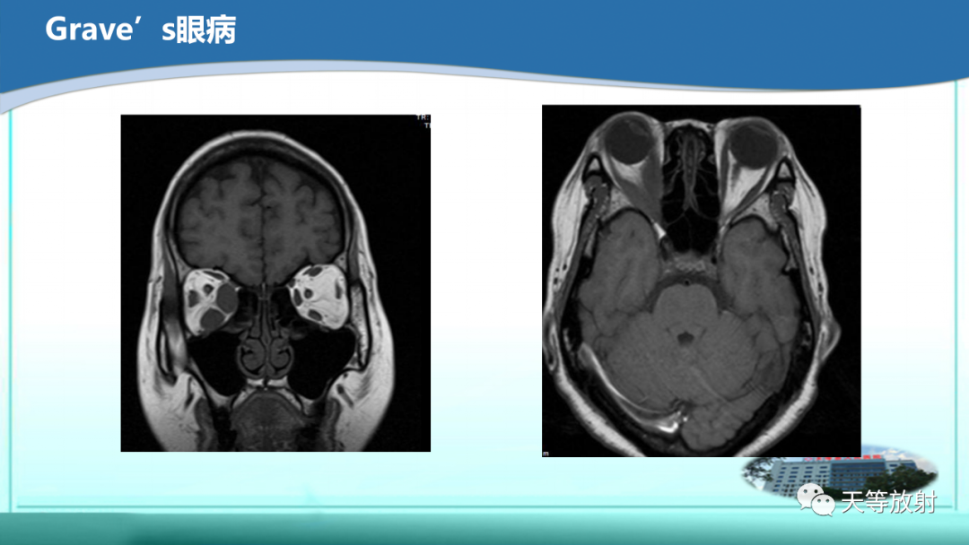 影像PPT - 【PPT】眼眶分区及各分区常见疾病-44