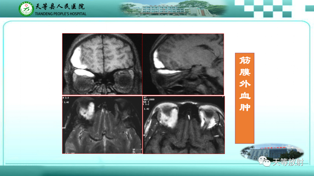 影像PPT - 【PPT】眼眶分区及各分区常见疾病-46