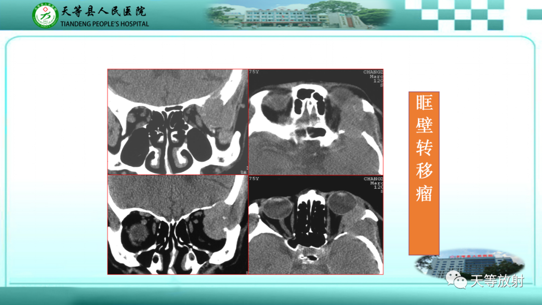 影像PPT - 【PPT】眼眶分区及各分区常见疾病-47