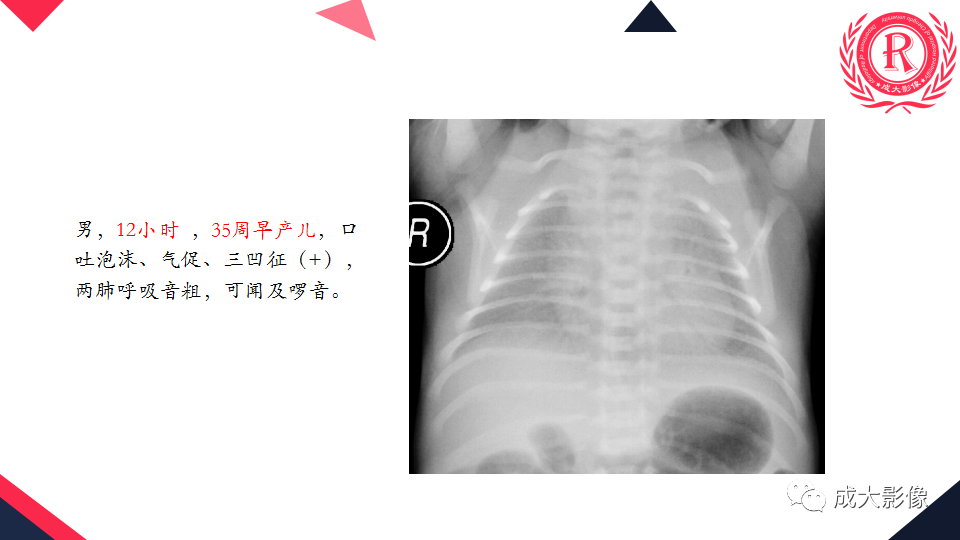 影像PPT - 【PPT】新生儿透明膜病的X线诊断与鉴别-14