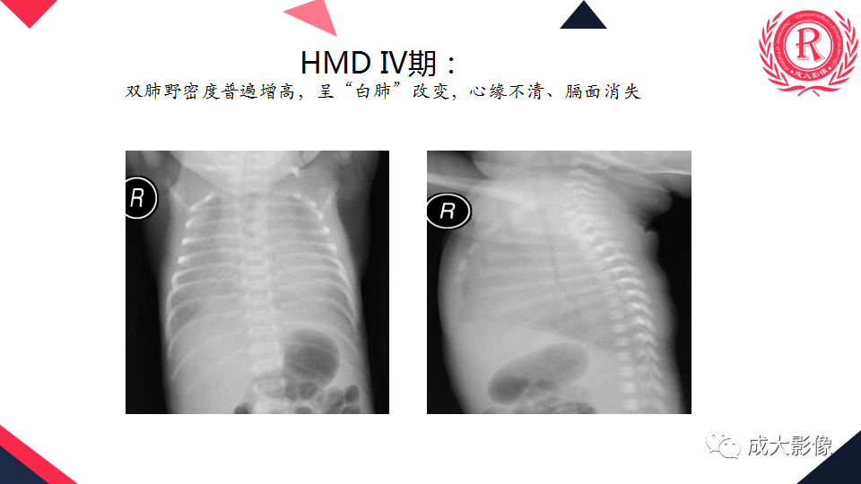 影像PPT - 【PPT】新生儿透明膜病的X线诊断与鉴别-13
