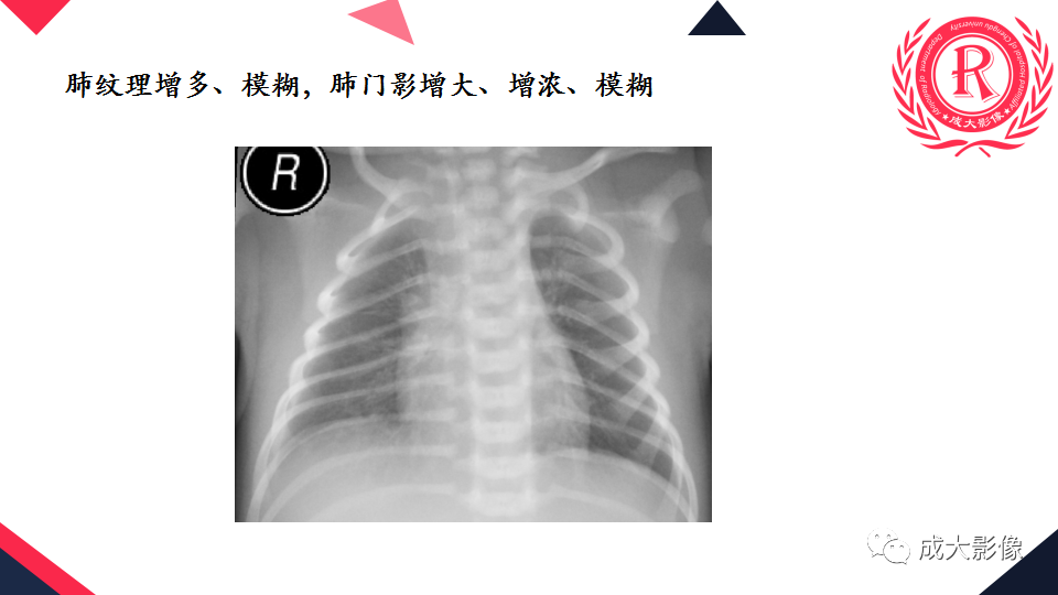 影像PPT - 【PPT】新生儿透明膜病的X线诊断与鉴别-19