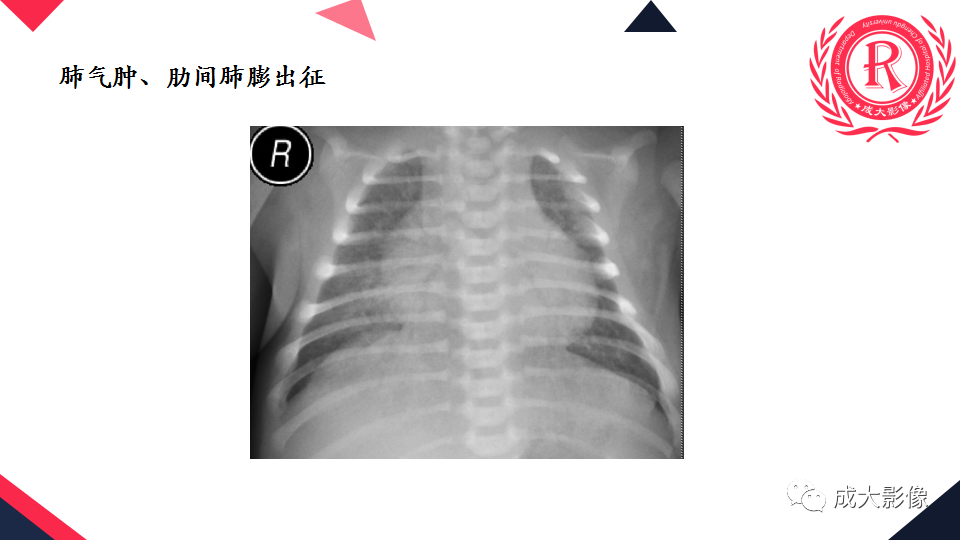 影像PPT - 【PPT】新生儿透明膜病的X线诊断与鉴别-21