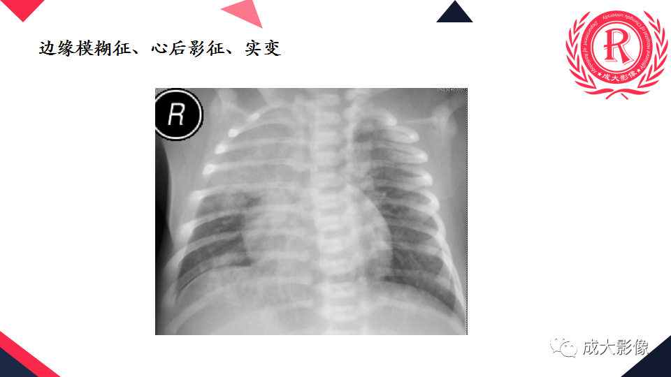 影像PPT - 【PPT】新生儿透明膜病的X线诊断与鉴别-22