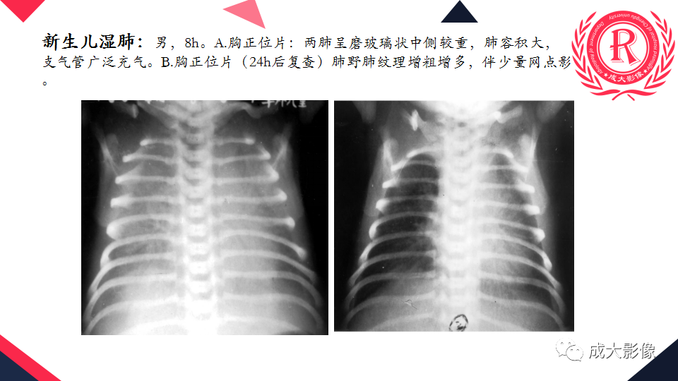 影像PPT - 【PPT】新生儿透明膜病的X线诊断与鉴别-30