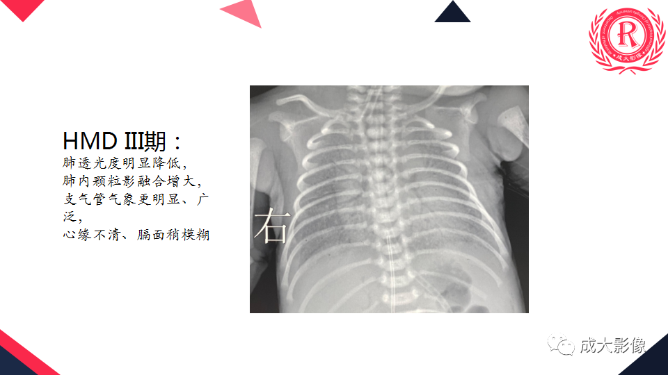 影像PPT - 【PPT】新生儿透明膜病的X线诊断与鉴别-10