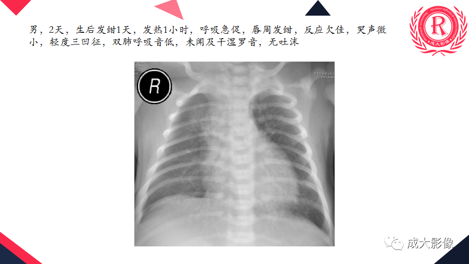 影像PPT - 【PPT】新生儿透明膜病的X线诊断与鉴别-17