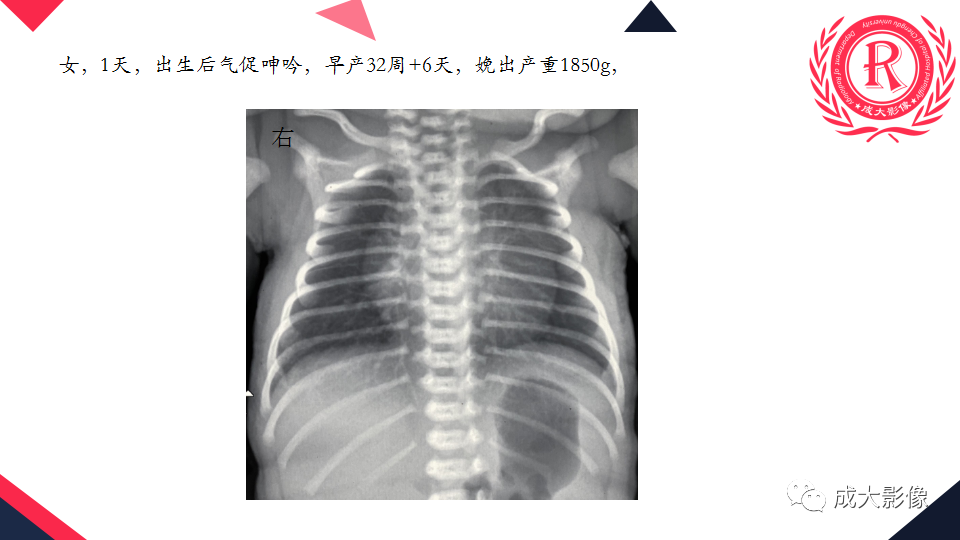 影像PPT - 【PPT】新生儿透明膜病的X线诊断与鉴别-21