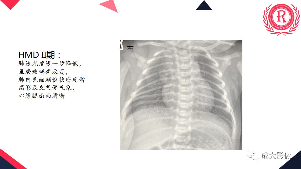 影像PPT - 【PPT】新生儿透明膜病的X线诊断与鉴别-3