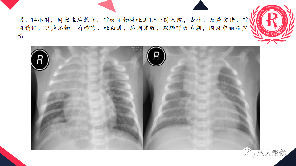 影像PPT - 【PPT】新生儿透明膜病的X线诊断与鉴别-4