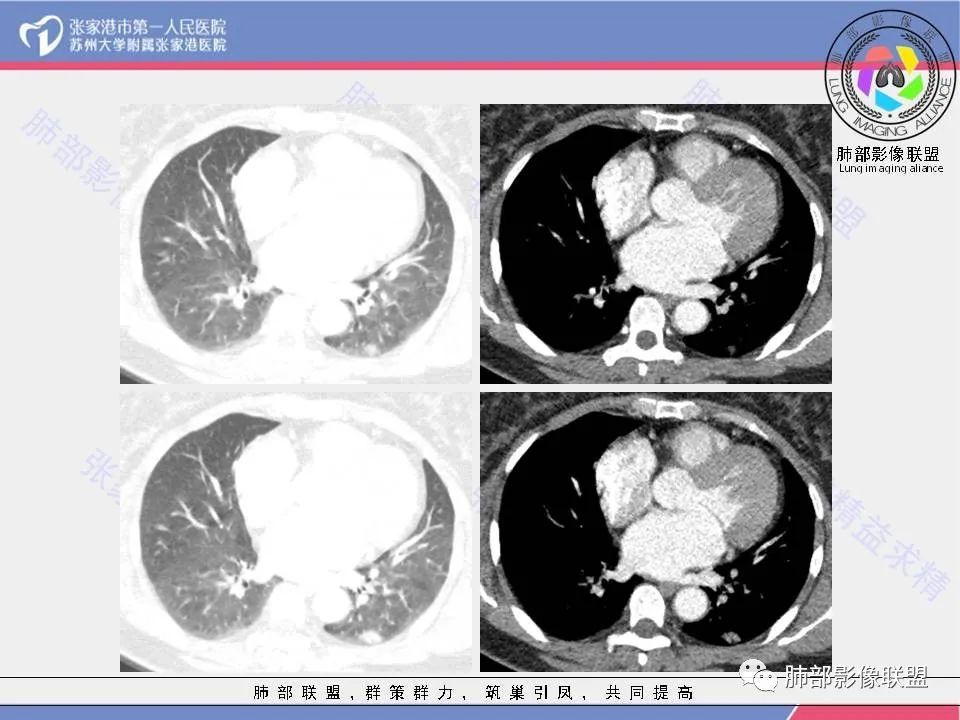 影像PPT - 【病例】一例肺胶样腺癌伴中心粗钙化灶CT-8 影像PPT - 【病例】一例肺胶样腺癌伴中心粗钙化灶CT-8