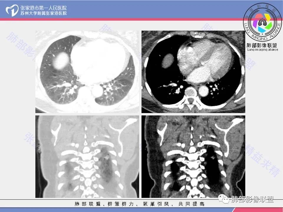 影像PPT - 【病例】一例肺胶样腺癌伴中心粗钙化灶CT-12 影像PPT - 【病例】一例肺胶样腺癌伴中心粗钙化灶CT-12