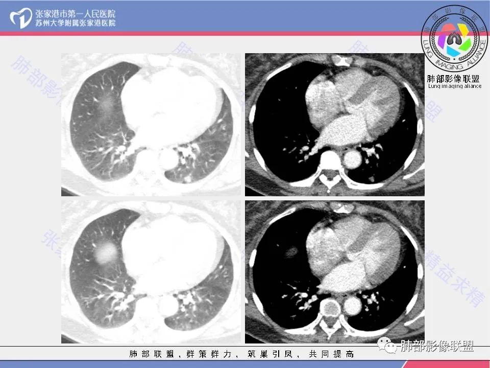 影像PPT - 【病例】一例肺胶样腺癌伴中心粗钙化灶CT-11 影像PPT - 【病例】一例肺胶样腺癌伴中心粗钙化灶CT-11