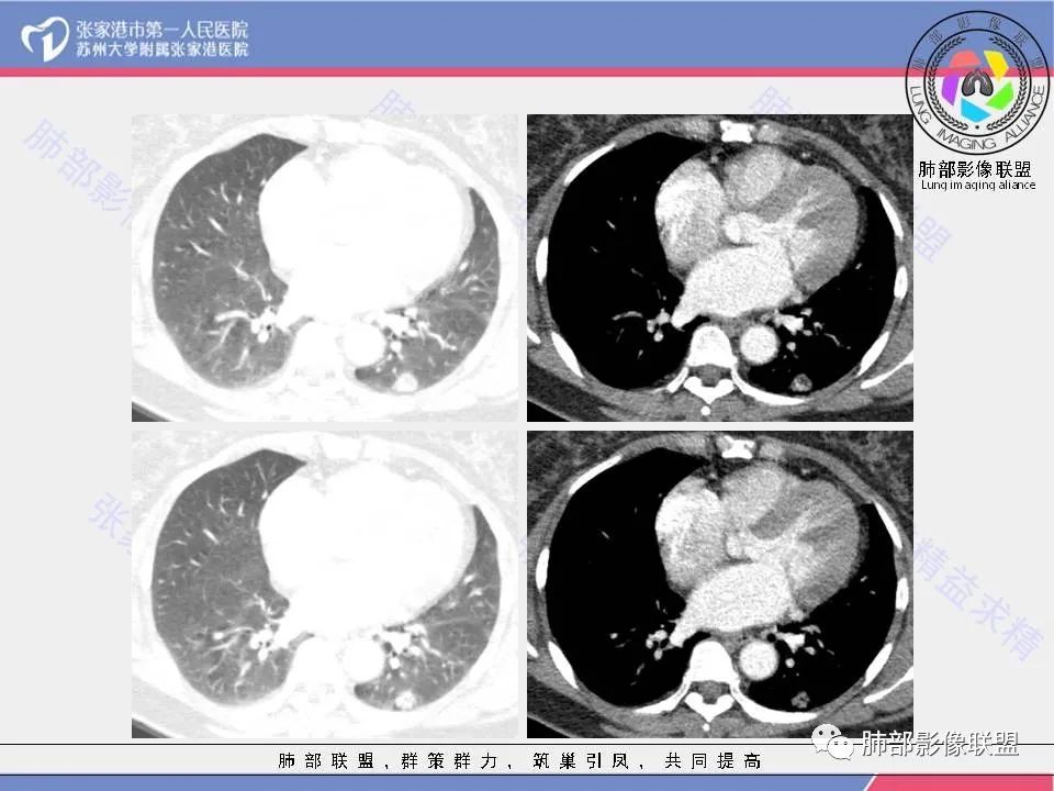 影像PPT - 【病例】一例肺胶样腺癌伴中心粗钙化灶CT-10 影像PPT - 【病例】一例肺胶样腺癌伴中心粗钙化灶CT-10