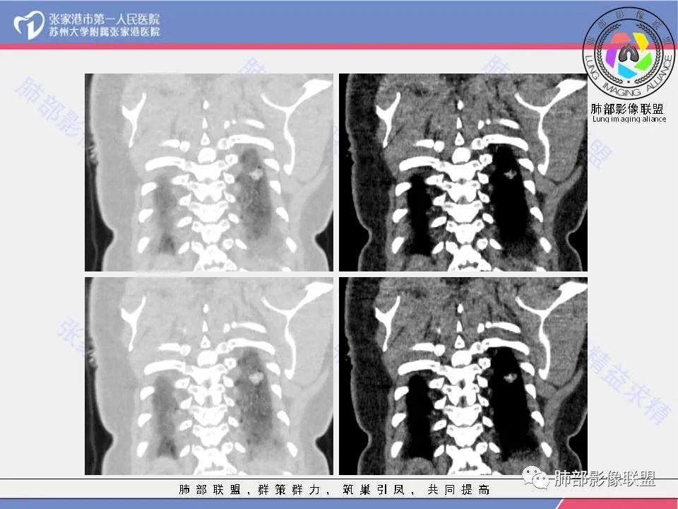 影像PPT - 【病例】一例肺胶样腺癌伴中心粗钙化灶CT-13 影像PPT - 【病例】一例肺胶样腺癌伴中心粗钙化灶CT-13