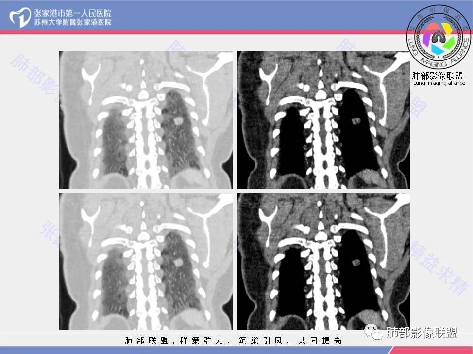 影像PPT - 【病例】一例肺胶样腺癌伴中心粗钙化灶CT-16 影像PPT - 【病例】一例肺胶样腺癌伴中心粗钙化灶CT-16