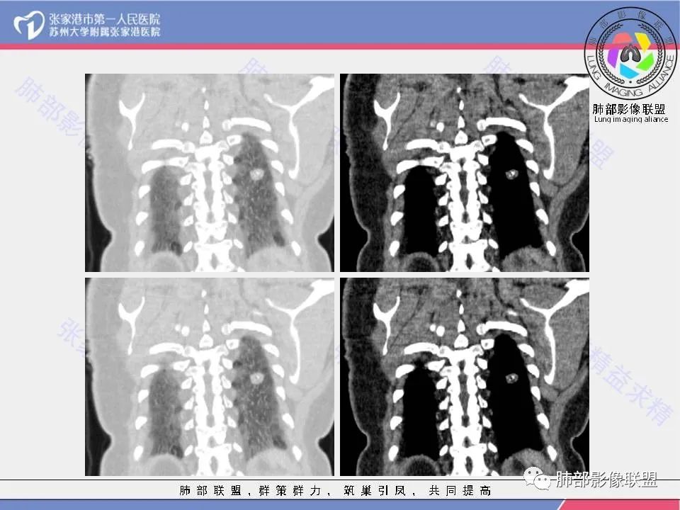 影像PPT - 【病例】一例肺胶样腺癌伴中心粗钙化灶CT-15 影像PPT - 【病例】一例肺胶样腺癌伴中心粗钙化灶CT-15