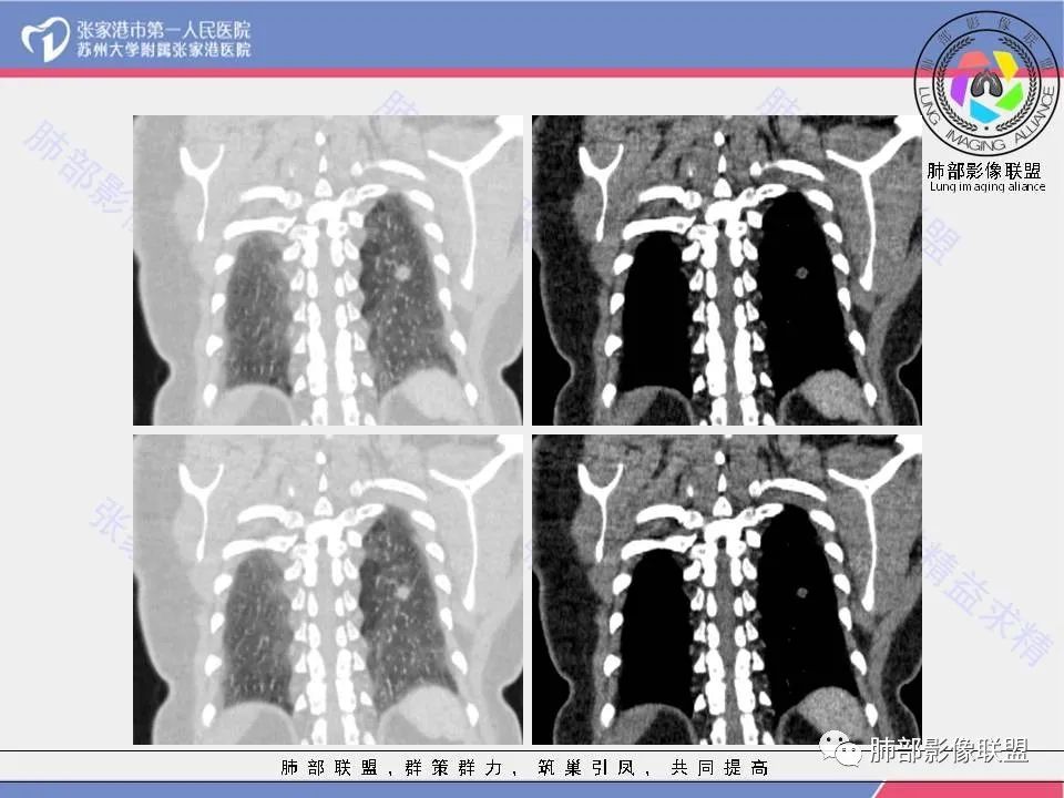 影像PPT - 【病例】一例肺胶样腺癌伴中心粗钙化灶CT-18 影像PPT - 【病例】一例肺胶样腺癌伴中心粗钙化灶CT-18